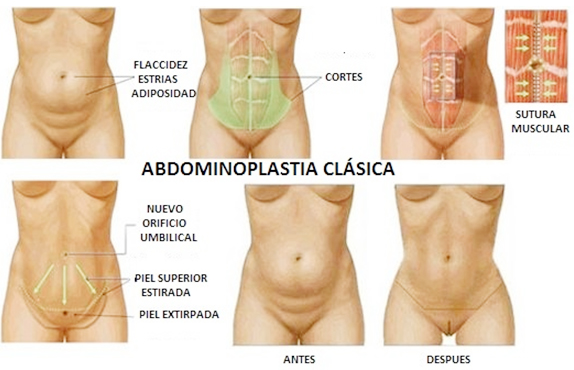 Abdominoplastia clásica